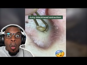 These BLACKHEADS Are INSANE! | Best Pimple Popping/Social media videos (Compilation #3)