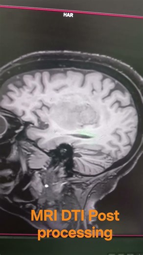 MRI DTI Post processing short video