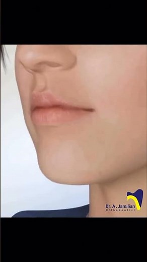 Surgical Orthodontics: Genioplasty, Mandibular Advancement, Mandibular Setback, Maxillary Impaction