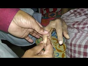 Hoffman's Sign How to Examine // upper motor neuron lesion // upper limb examination