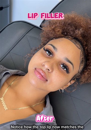 First Time Lip Filler: A Subtle and Natural Experience