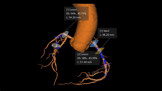 syngo.CT Coronary Cockpit