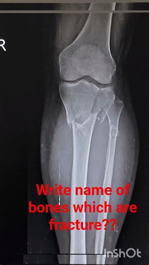 Name of bone which are fracture??