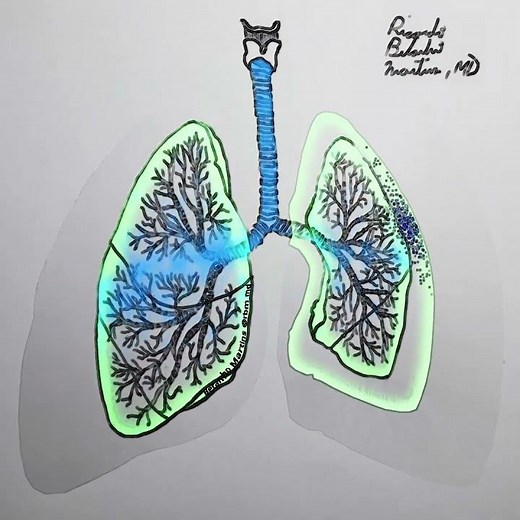 Pneumothorax Pathophysiology shown in 30 seconds