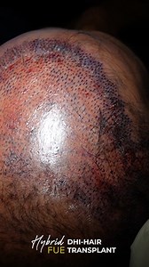 4.3K views · 19 reactions | Today's procedure at Hair Club: FUE Hair...