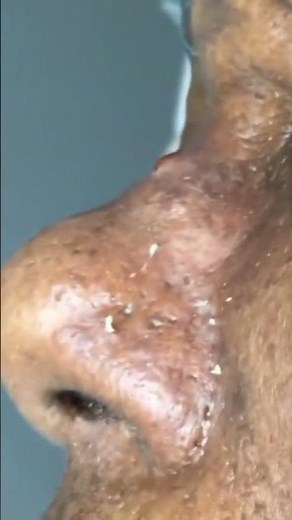 Satisfying Pimple Popping | Blackheads And Acne - Best Pimple Popping Compilation Videos #Shorts