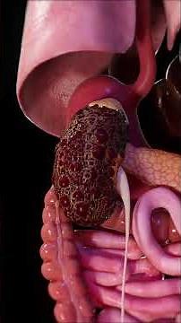 ⚠️ Polycystic Kidney Disease: When Cysts Take Over ⚠️