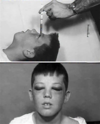 In December 1960, a 12-year-old boy named Howard Dully became one of the youngest patients ever to receive a transorbital lobotomy — a procedure now remembered as one of the darkest chapters in medical history. His stepmother insisted that Howard was “difficult” and possibly schizophrenic. Most teachers and doctors disagreed. But one man—Dr. Walter Freeman, the self-proclaimed “father of the lobotomy”—was willing to proceed. With his father’s consent, the boy’s fate was sealed. “But Why did my f