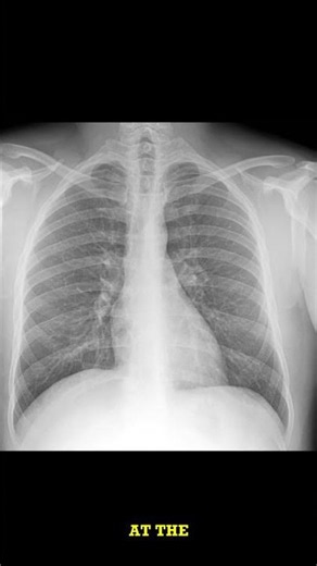 Chest X-ray Challenge: Spot the Bronchitis!