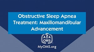 Obstructive Sleep Apnea Treatment: Maxillomandibular Advancement