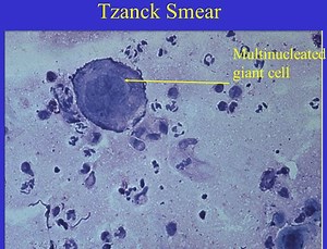 Tzanck smear test uses, procedure & Tzanck smear interpretation