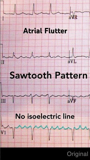 Atrial Flutter ECG: Sawtooth pattern