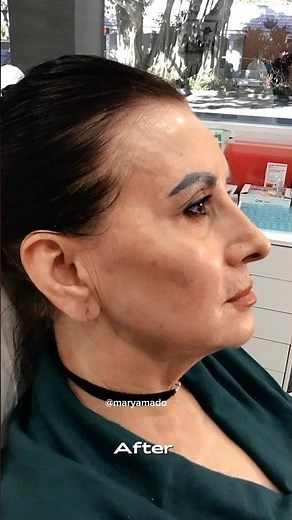 Antes y despues : Radiesse / Hilos Tensores / fillers / toxina botulinica