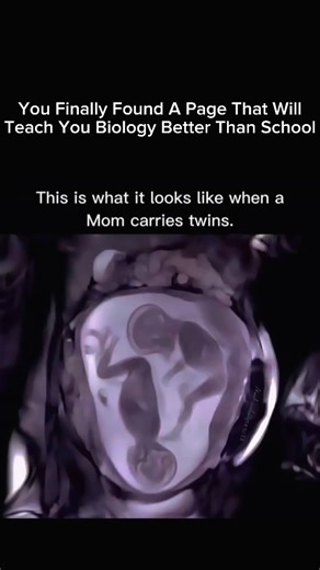 Explaining Biology | When a Mom Carries Twins 👶👶✨ When a mom is pregnant with twins, her body goes into super-mode. Here’s what’s happening inside: 🔸 Double... | Instagram