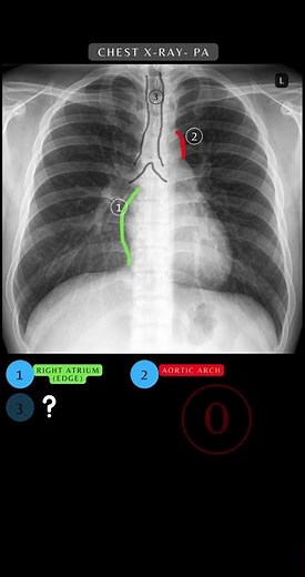 Chest X-ray Anatomy Quiz: Questions and Answers | Chest X-ray Anatomy #xray #respiratory