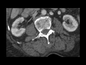 Glomerular Cystic Kidney Disease on CT