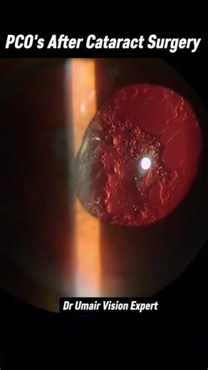 Posterior Capsule Opacification|Blurry Vision After Cataract Surgery|what is YAG?
