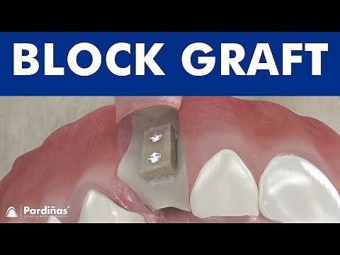 Dental bone graft for implants - Block Bone grafting ©