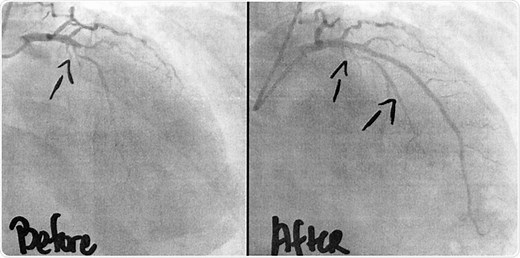What is a Balloon Occlusion Test?