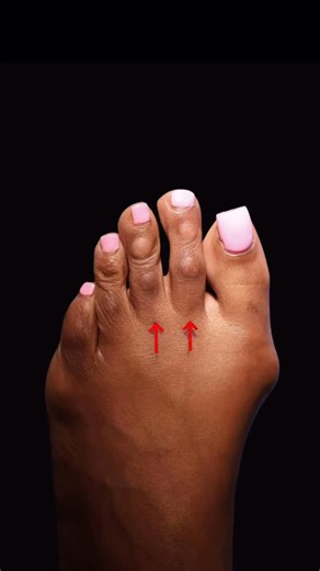 ✅ 10 Months After Surgery Results 💉Treatment: Minimally Invasive Toe Shortening Corn Removal Surgery 🎯Purpose: Alleviate pain and discomfort caused by the bunion and enhance the foot cosmetics 🤓 How it works: 1cm incision, cosmetic closure 🌟 Results: Immediate 😴 Anesthesia: Local ⏰ Time: 30-60 ❤️‍🩹Recovery: Inmediate weight bearing in post op shoe 📅 Lasts: Permanent 📍Location: 7975 NW 154th St Unit 244 Miami Lakes, FL 33016 United States 📲 Phone Number: (786) 610 - 3666 | Luxe Foot Surg