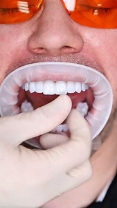 272K views · 1.3K reactions | All-on-6 | Dr. Mikael D.Aslanyan, DMD, DDS | Facebook