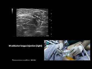 Ultrasound guided lower limb botulinum toxin injections in cerebral palsy, Murat Karkucak MD
