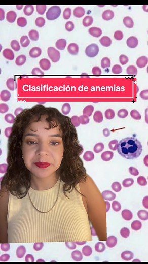Clasificación y Tipos de Anemia en Hematología