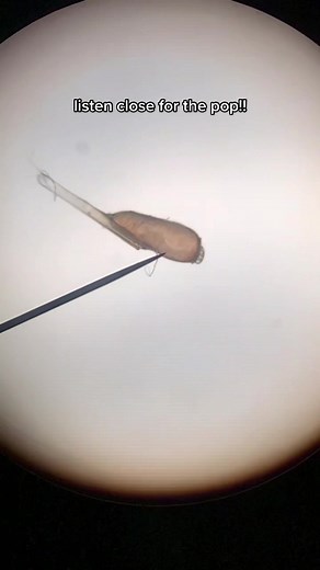 Crushing Lice Eggs Under a Microscope