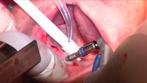 Full Arch Guided Implants with Bone Expansion