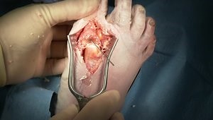 1st MTP Fusion Utilizing a Low-Profile Variable Angle Locking Compression Plate