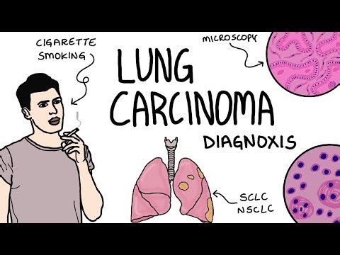 Lung carcinoma- Etiopathogenesis,types,Morphology(gross&microscopy),symptoms,diagnosis,complications