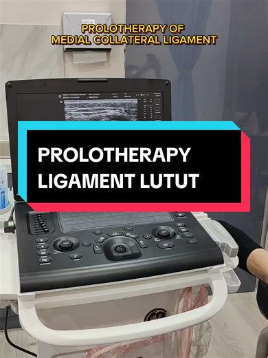 Prolotherapy of the knee. . Prolotherapy is a nonsurgical regenerative technique that allows small amounts of irritant solution to be injected into the site of painful tendon and ligament insertions to promote the growth of healthy cells and tissues. The goal of prolotherapy is to stimulate growth factors that may strengthen attachments and reduce pain. Connie et al 2023. . So here I injected a 16.7% dextrose solution under ultrasound guidance into the MCL of the patient's knee due to persistent
