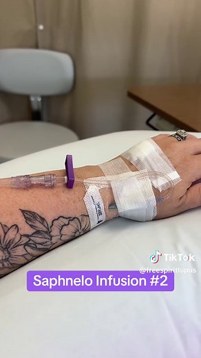 Saphnelo Infusion for Lupus Treatment Explained