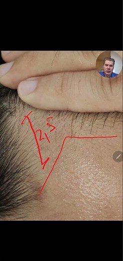 First Regrowth In Temples and Hairline #hairgrowth