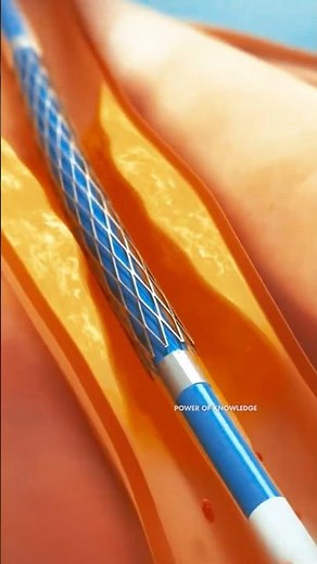 How Angioplasty Procedure Is Performed? | Balloon Angioplasty And Coronary artery stent Procedure