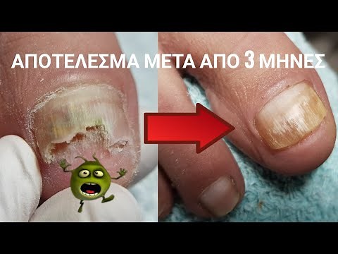 Κουφιο νυχι στα ποδια/ πεντικιουρ/ διορθωση προβληματικου νυχιου