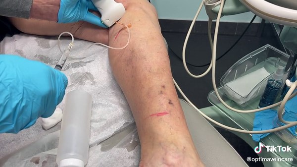 Venous Reflux is caused by Faulty Valves. Treatments close the incompetent veins. #varicoseveins #sclerothereapy #varithena #venaseal #EVLT #foamsclerotherapy #venousstasis