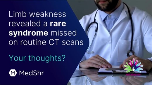Limb weakness revealed a rare paraneoplastic syndrome tied to anti-CRMP5 antibodies. Surprising twist: Small cell lung cancer found in a solitary lymph node, initially unnoticed on routine CT scans. https://hubs.la/Q02mh4T90 | MedShr