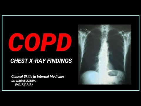 COPD (Chest X-ray findings)