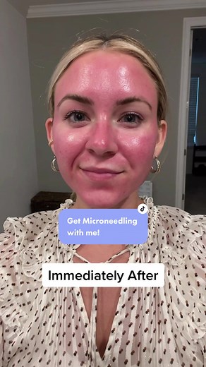 Enhance Your Skin with SkinPen Microneedling Treatment