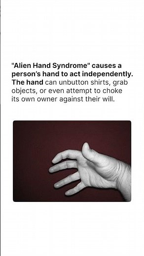 "Alien Hand Syndrome" causes a person’s hand to act independently