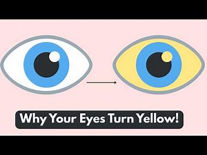 Jaundice Explained: Causes, Symptoms & Treatment