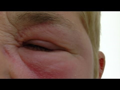 Treatment of gross eye swelling following an insect bite