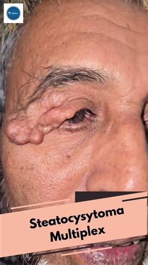 Steatocystoma Multiplex || #youtubeshorts #youtubechannel #youtube #diagnosis #medicine #mbbs ||