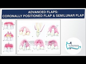 ADVANCED (PEDICLE) FLAPS| CORONALLY POSITIONED FLAP| SEMILUNAR FLAP| ROOT COVERAGE| DR. ANKITA