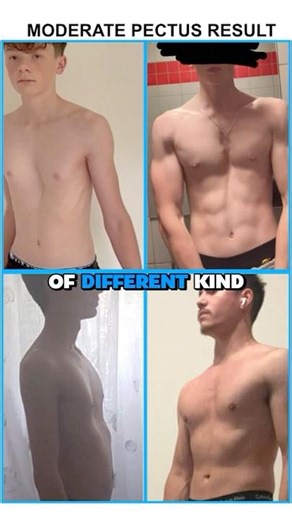 How Much You Can Fix Pectus? (By Severity)