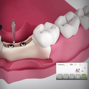 1.3M views · 5.2K reactions | Implants in thin Ridges. Dentistry #LearningTips #BitesnBraces | Bites & Braces Dental | Facebook