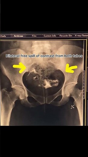 Hysterosalpingogram (HSG) #fluoroscopy #radiology#medicaleducation