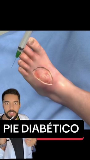 #diabetes #piediabetico #medicosdetiktok #estudiantedemedicina #medicina