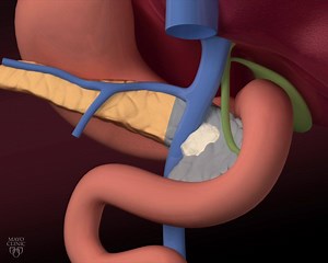 3.7K reactions · 1.1K shares | Mayo Clinic is a leader in Pancreatic Ductal Adenocarcinoma treatment. Learn more about Mayo Clinic pancreatic cancer care. | Mayo Clinic | Facebook